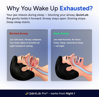 QuietLab Pro® Mouth Guard for Sleeping